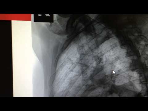 how to treat broken ribs