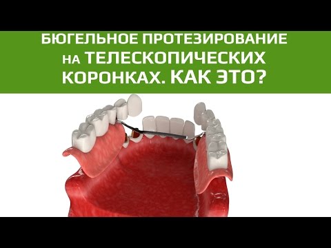 Бюгельный протез на телескопических коронках