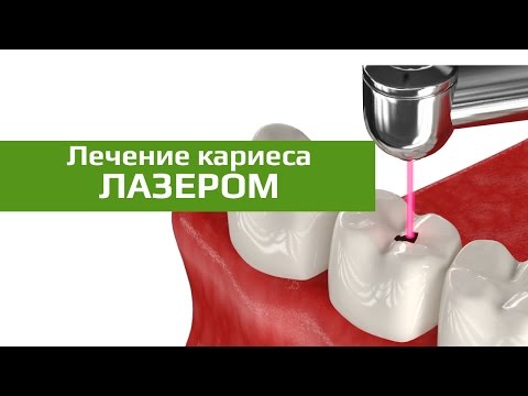 Удаление кариеса лазером