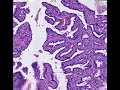 Histopathology Breast--Intraductal papilloma