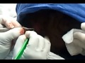 Cyst Removal from the back of Head