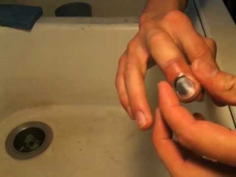 how to relieve smashed finger