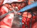 SKULL BASE meningioma tuberculum sella -microsurgical total excission-dr suresh dugani/hubli/india