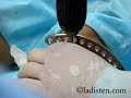Bow legs correction, 2. http://www.ladisten.com