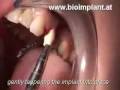 videos de WORLD`S FIRST IMMEDIATE ROOT-ANALOG ZIRCONIA DENTAL IMPLANT