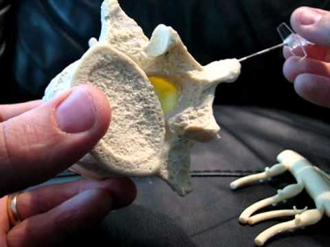 how to measure epidural catheter