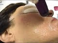800 Nm Diode Laser for Hair Removal