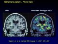 The Role of Inflammation in Neurodegenerative Disorders and Current Concepts in Neurodegeneration Part 1 of 15