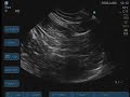 USG-Anterior Sciatic Nerve Block for pediatric patients USG-Anterior Sciatic Nerve Block for pediatric patients