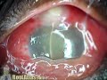 Ophthalmology Finding: Endophthalmitis from blebitis (ophthalmology)