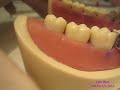 Class II Composite Part 2/3