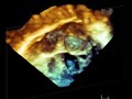 Aneurismal atrial septum, ASD Aneurismal atrial septum, ASD