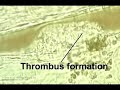 Venous thrombus formation and break away  Deep Vein Thrombosis Venous Thrombosis