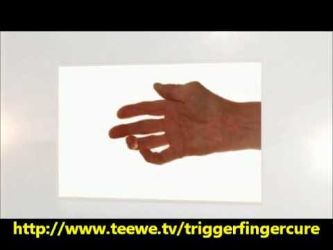 how to cure trigger finger
