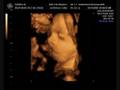 4D Ultrasound~27 Weeks Gestation