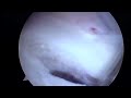 my shoulder surgery