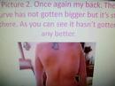 .X.Scoliosis Sucks!.X. .X.Scoliosis Sucks!.X.