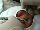 Eye Surgery Eye Surgery