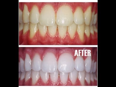 how to treat yellow teeth