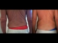 Tummy Tuck, NO SURGERY!!? | 407-374-2114