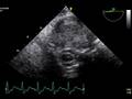 videos de TEE Spinal cord