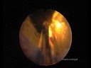 HPS Green Light Laser Teil 1