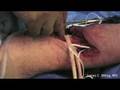 Excision Of Distal End Of Humerus Due To Giant Cell Tumor - 6/6