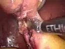 Clipless laparoscpic cholecystectomy Cholecystectomy