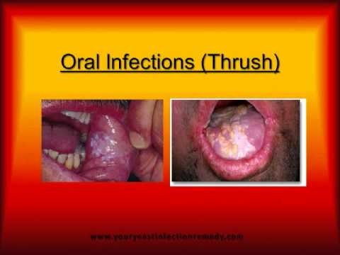 how to recover yeast infection