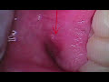 Tooth & Gum Abscesses : Relieving the Pain of an Abscessed Tooth  Abscesses Infections