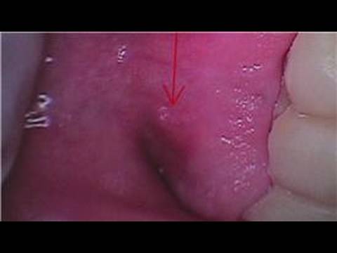 how to relieve dental abscess