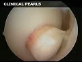 Osteochondral Autograft (sample) - www.proceduresconsult.com