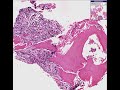 Histopathology Bone, vertebrae--Osteomyelitis and chondritis Histopathology Bone, vertebrae--Osteomyelitis and chondritis