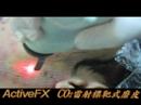 Active FX Laser Acne Scar Removal(ActiveFX????CO2??????????) Active FX Laser Acne Scar Removal(ActiveFX????CO2??????????)