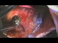 Maxillary Lingual Corticotomy Pt 5