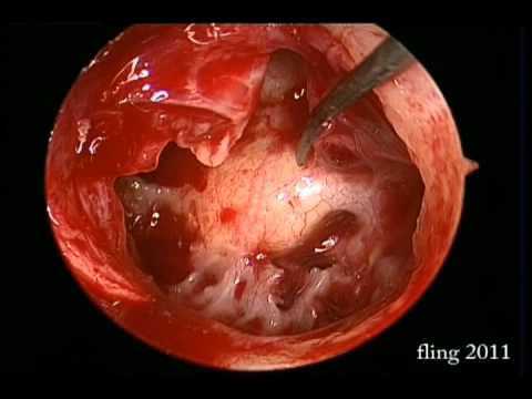 Left Ear Tympanoplasty - Endoscopy