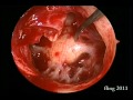 Left Ear Tympanoplasty - Endoscopy Left Ear Tympanoplasty - Endoscopy