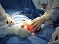 Cirugia tumor testicular Cirugia tumor testicular