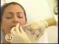 Plastic surgeon - Juvederm Restylane filler injections shots