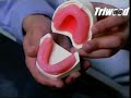 Making Dentures Making Dentures
