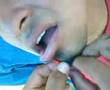 perforasion