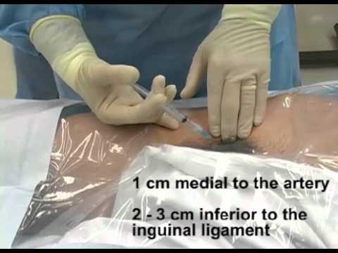 how to locate femoral vein