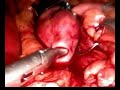 Cirugia Antireflujo por Laparoscopia parte II