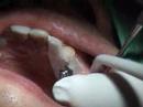 part-2-nobel-guided-implantscal-prosthesis-stumpel-dds.html