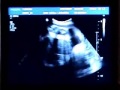 Echographie 32 SA