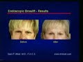 Endoscopic Browlift