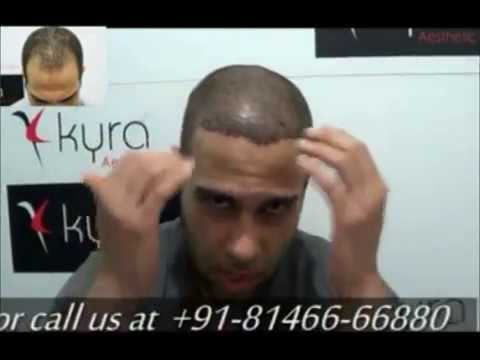 how to hair transplant in india