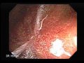 parasite in the colon whipworm trichuris trichiura