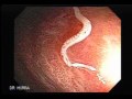 Parasite in the Colon whipworm Trichuris trichiura