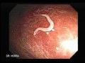 parasite in the colon whipworm trichuris trichiura